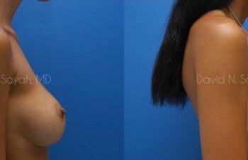 Breast Implant Revision Before and After | Sayah Institute