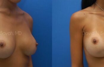 Breast Implant Revision Before and After | Sayah Institute