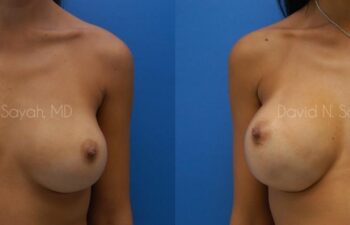 Breast Implant Revision Before and After | Sayah Institute