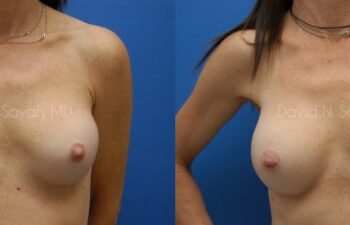 Breast Implant Revision Before and After | Sayah Institute