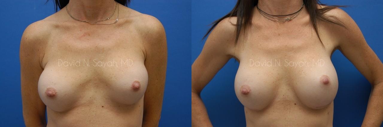Breast Implant Revision Before and After | Sayah Institute