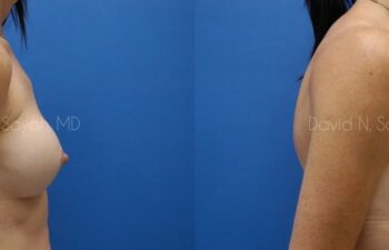 Breast Implant Revision Before and After | Sayah Institute