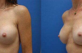 Breast Implant Revision Before and After | Sayah Institute