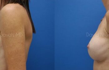 Breast Implant Revision Before and After | Sayah Institute