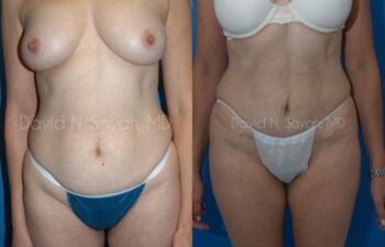 Mini Tummy Tuck Before and After | Sayah Institute