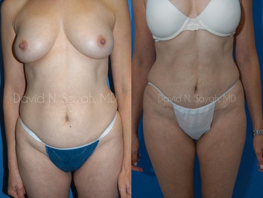 Mini Tummy Tuck Before and After | Sayah Institute