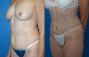 Mini Tummy Tuck Before and After | Sayah Institute