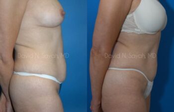 Mini Tummy Tuck Before and After | Sayah Institute