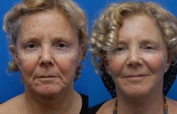 Co2 Laser Before and After | Sayah Institute