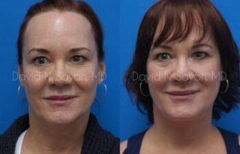 Fat Injection Face Before and After | Sayah Institute