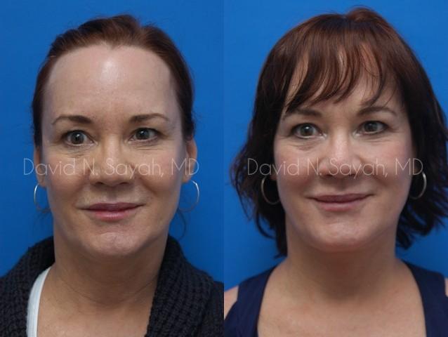 Fat Injection Face Before and After | Sayah Institute