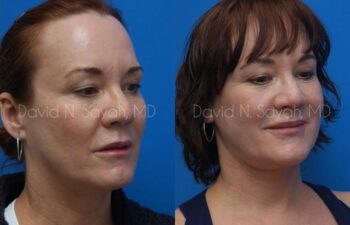 Fat Injection Face Before and After | Sayah Institute