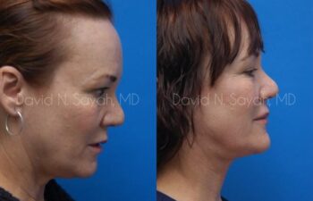 Fat Injection Face Before and After | Sayah Institute