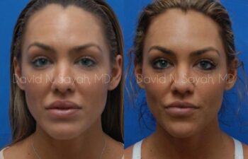 Rhinoplasty Before and After | Sayah Institute