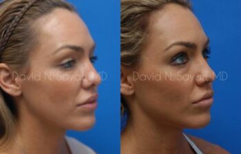 Rhinoplasty Before and After | Sayah Institute