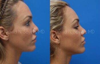 Rhinoplasty Before and After | Sayah Institute