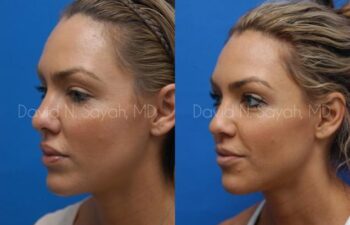 Rhinoplasty Before and After | Sayah Institute
