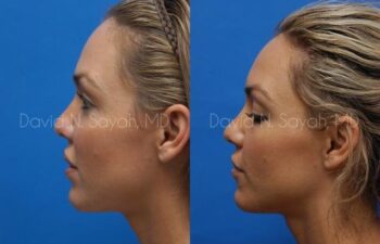 Rhinoplasty Before and After | Sayah Institute