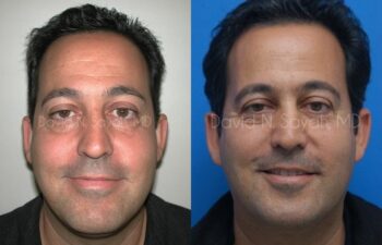 Eyelid Surgery Before and After | Sayah Institute