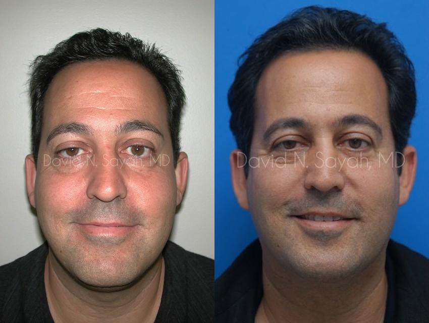 Eyelid Surgery Before and After | Sayah Institute