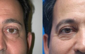 Eyelid Surgery Before and After | Sayah Institute