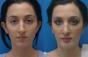 Ear Surgery Before and After | Sayah Institute