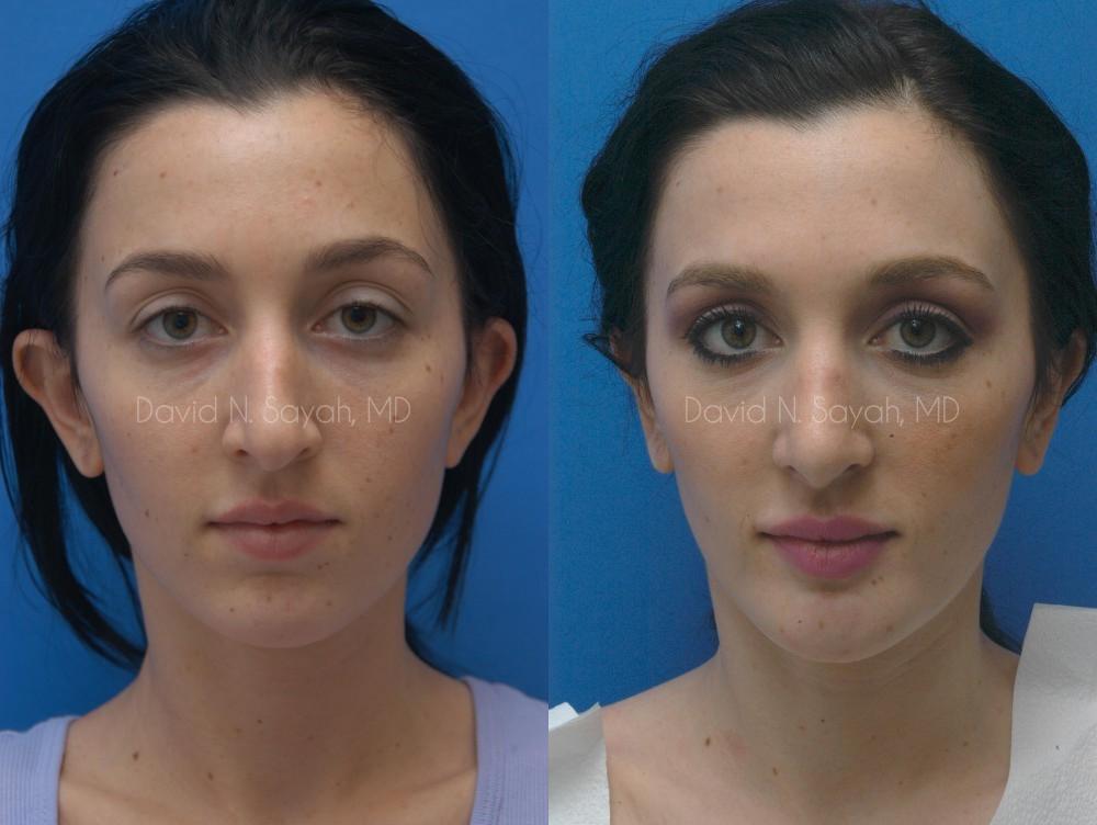 Ear Surgery Before and After | Sayah Institute