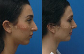 Ear Surgery Before and After | Sayah Institute