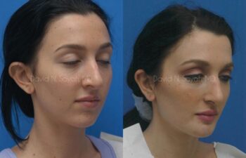 Ear Surgery Before and After | Sayah Institute