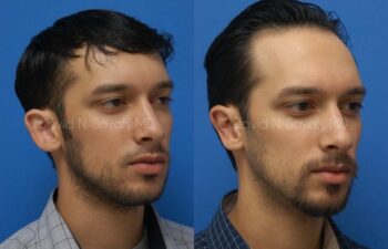 Ear Surgery Before and After | Sayah Institute