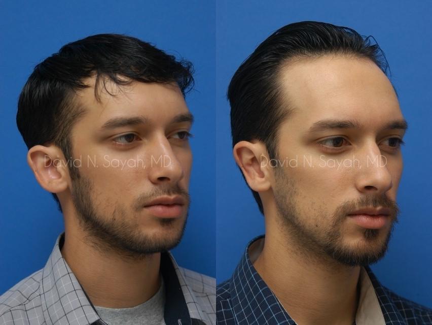 Ear Surgery Before and After | Sayah Institute
