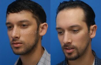 Ear Surgery Before and After | Sayah Institute