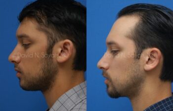 Ear Surgery Before and After | Sayah Institute