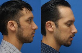 Ear Surgery Before and After | Sayah Institute