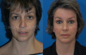 Endoscopic Facelift Before and After | Sayah Institute