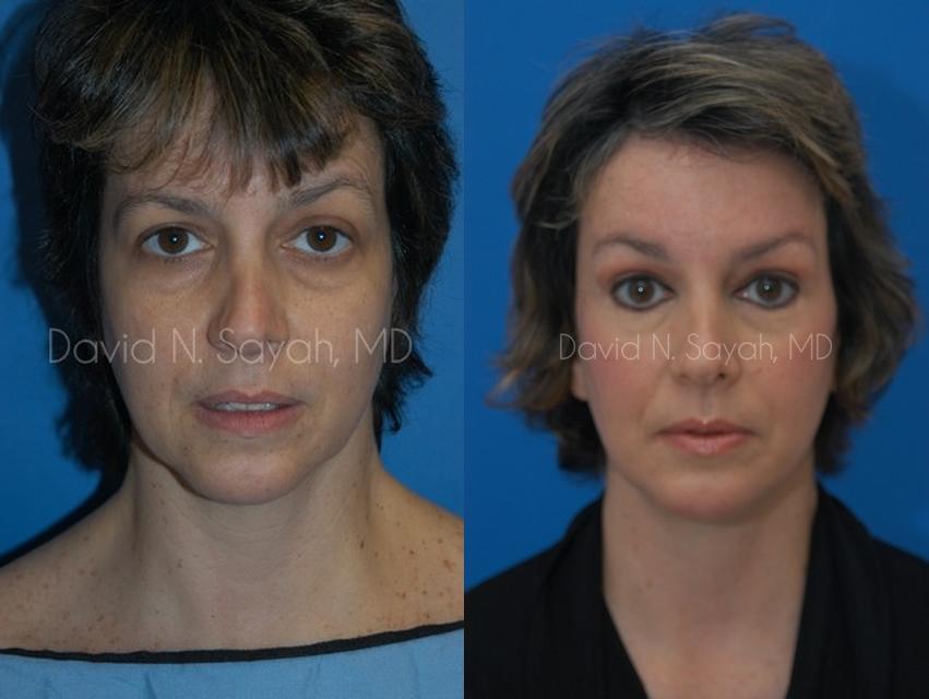 Endoscopic Facelift Before and After | Sayah Institute