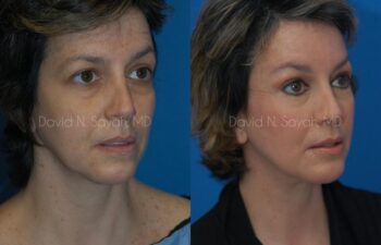 Endoscopic Facelift Before and After | Sayah Institute