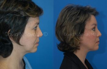 Endoscopic Facelift Before and After | Sayah Institute