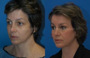 Endoscopic Facelift Before and After | Sayah Institute