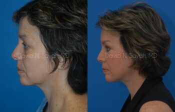 Endoscopic Facelift Before and After | Sayah Institute
