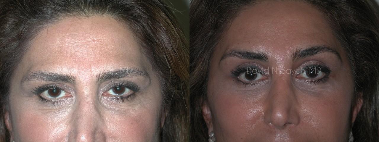 Endoscopic Facelift Before and After | Sayah Institute