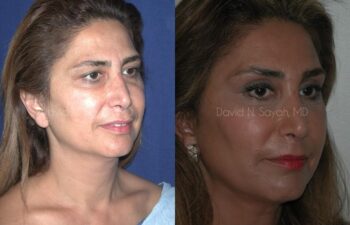 Endoscopic Facelift Before and After | Sayah Institute