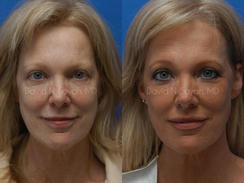 Chemical Peel Before and After | Sayah Institute