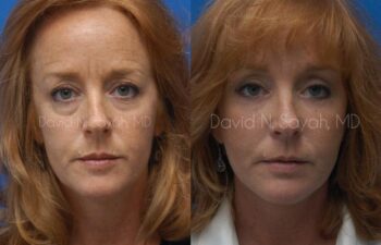 Facelift Before and After | Sayah Institute