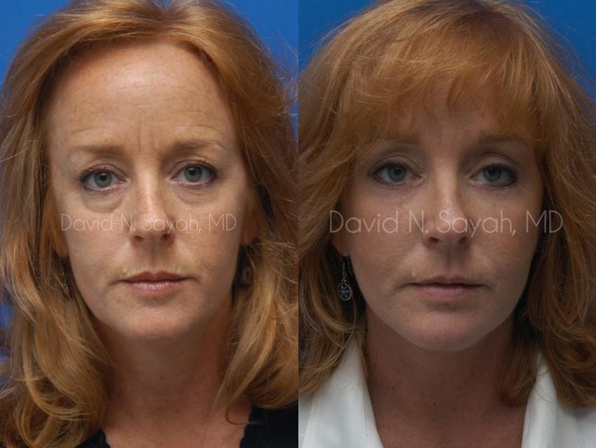 Facelift Before and After | Sayah Institute