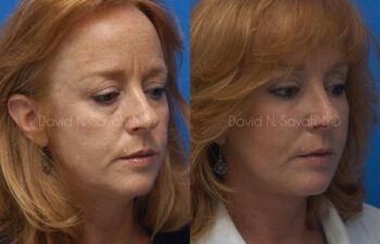 Facelift Before and After | Sayah Institute