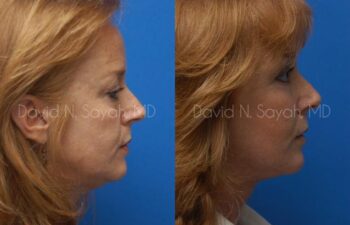 Facelift Before and After | Sayah Institute