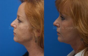 Facelift Before and After | Sayah Institute