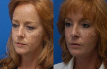 Facelift Before and After | Sayah Institute