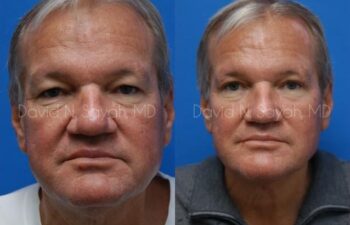 Facelift Before and After | Sayah Institute